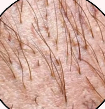 Before - 2–4 weeks