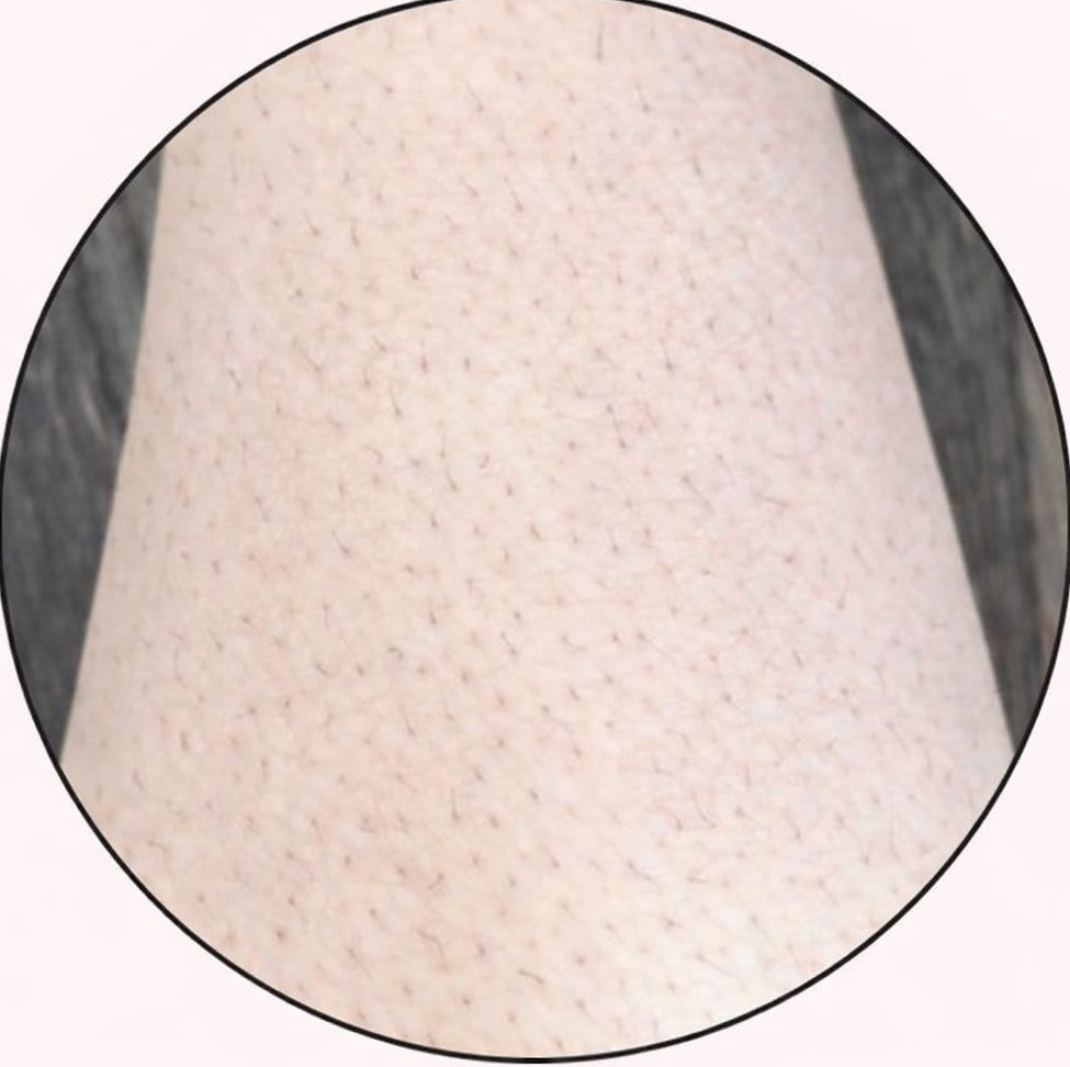 Before - 5–8 weeks