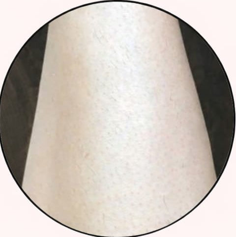 After - 5–8 weeks