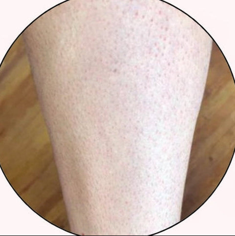 Before - 8–12+ weeks